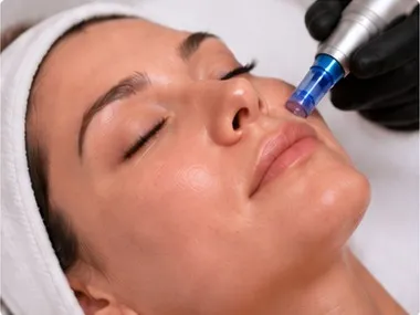 Microneedling with PRP along the nose and cheek